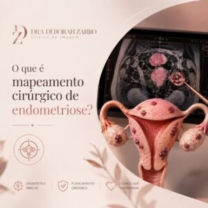 Ilustração sobre mapeamento cirúrgico de endometriose, mostrando a avaliação detalhada das lesões e o planejamento cirúrgico para tratamento da endometriose profunda.